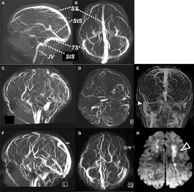 Cerebral Sinovenous Thrombosis